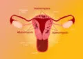 Adenomiozė