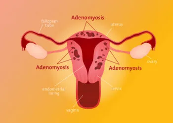 Adenomiozė