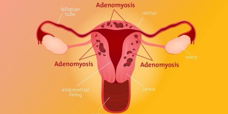 Adenomiozė
