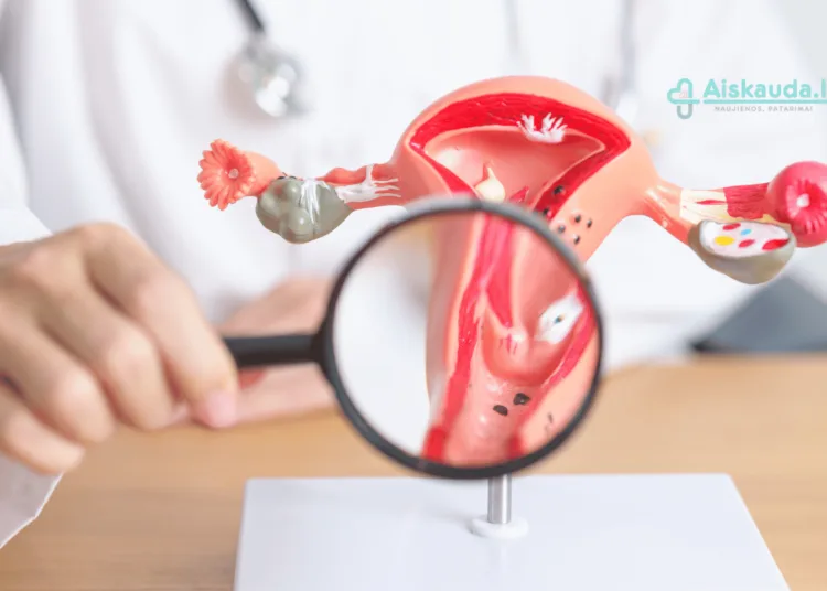 Endometriozė