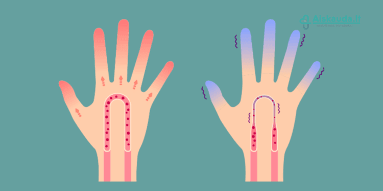 liaudiški patarimai kraujotakai gerinti